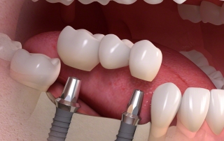 Implantatgetragene Brücke
